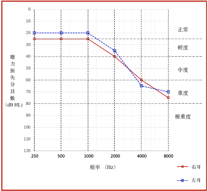 典型的與年齡有關的聽力損失聽力圖