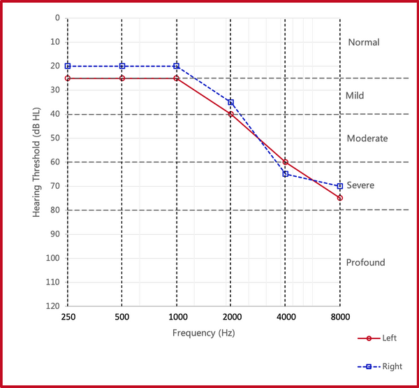 Typical Audiogram Age-Related Hearing Loss