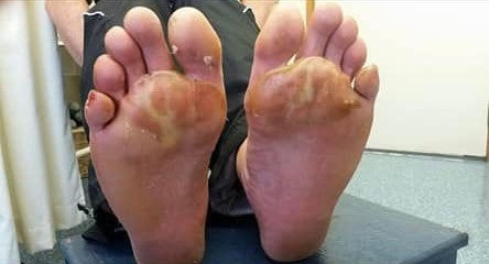 feet in a doctor's room with massive blistering.