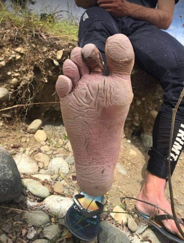 A man holding his foot to the camera, with damp and wrinkled trench foot.