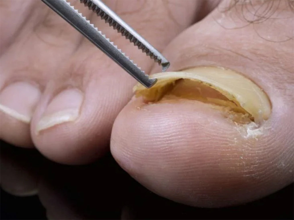 How to Get Rid of Ingrown Fingernails