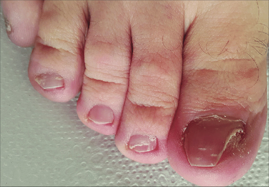 How to Get Rid of Ingrown Fingernails