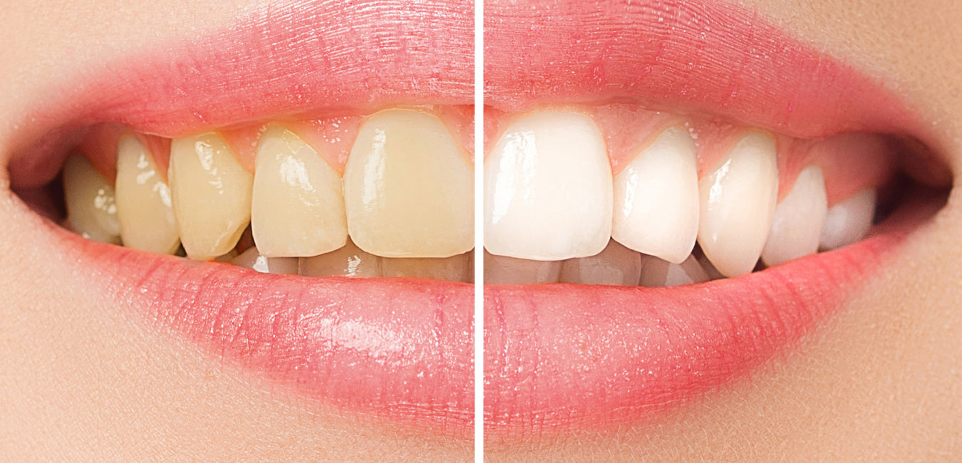 how to whiten yellow teeth from smoking