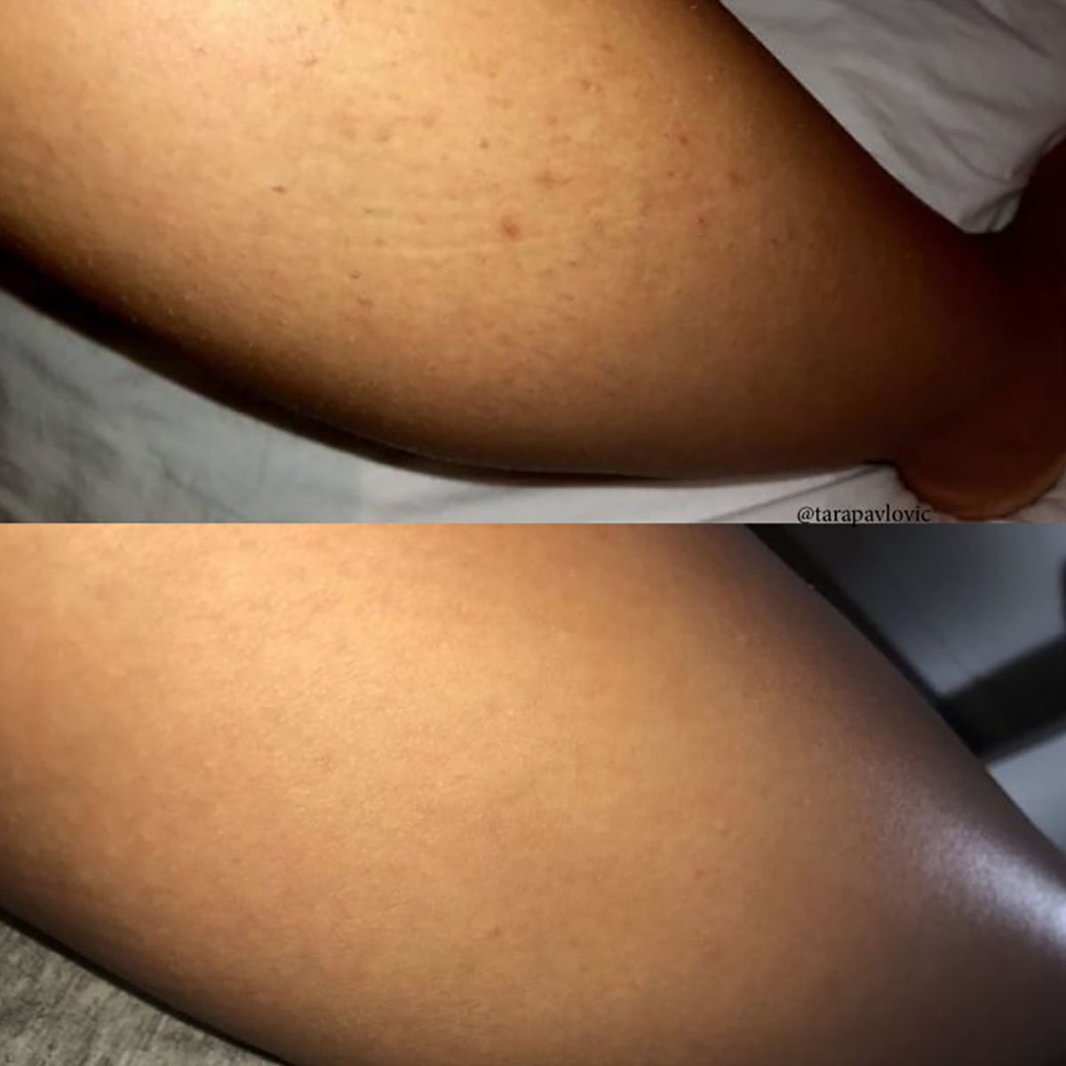 How to Prevent Ingrown Hairs on Your Legs with Pictures