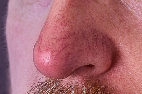 ROSACEA ON THE NOSE