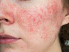 Papulopustular rosacea