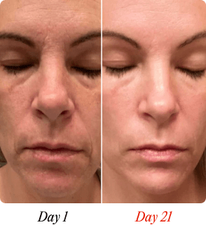 'Before and after comparison of a woman's face over 21 days, showing skin improvement.'