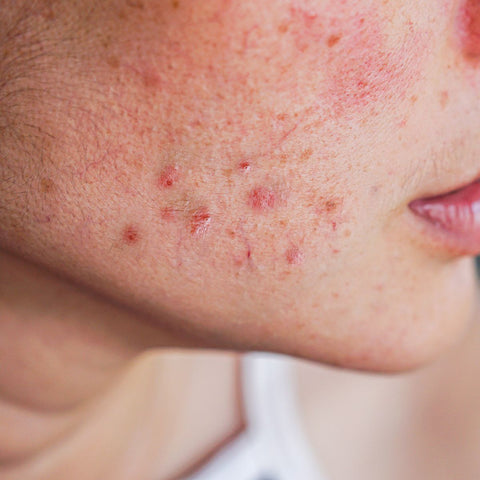 remedies for blemishes
