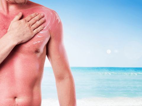 Sonnenbrand erhöht Hautkrebsrisiko