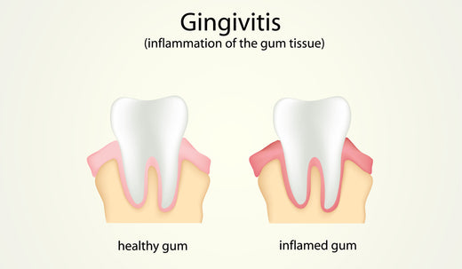 mild periodontitis