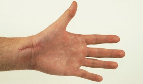 Helping wrist scar tissue with paraffin wax