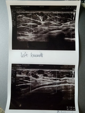 Ultrasound Image Stage 2 Ductal Invasive Carcinoma