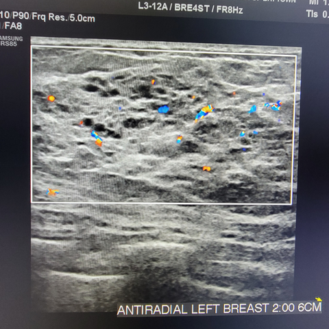 Breast Ultrasound Image