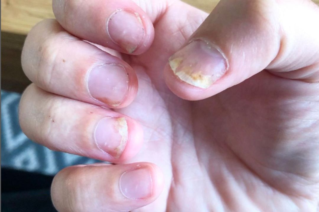 Nail Psoriasis - Fix My Psoriasis