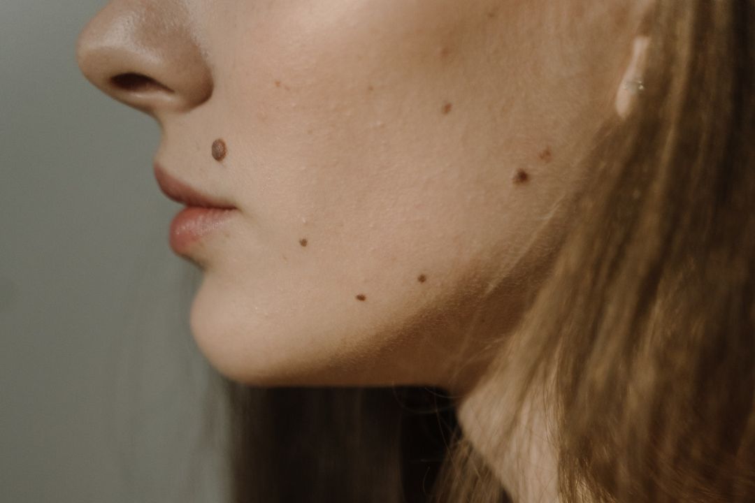 What is Mole Mapping? How To Map Your Moles