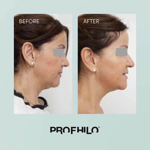 profhilo before and after