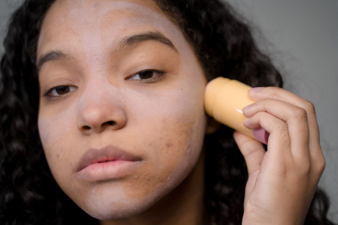 What Is Acne? Understanding Your Skin Is The First Step To Treating Your Acne