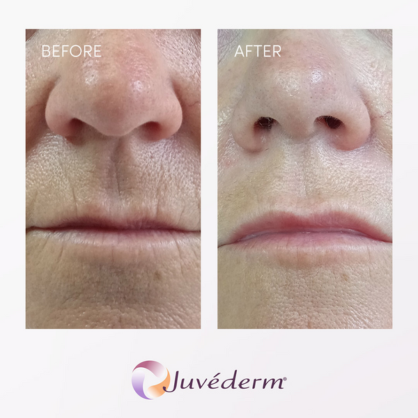 juvederm filler before and after 