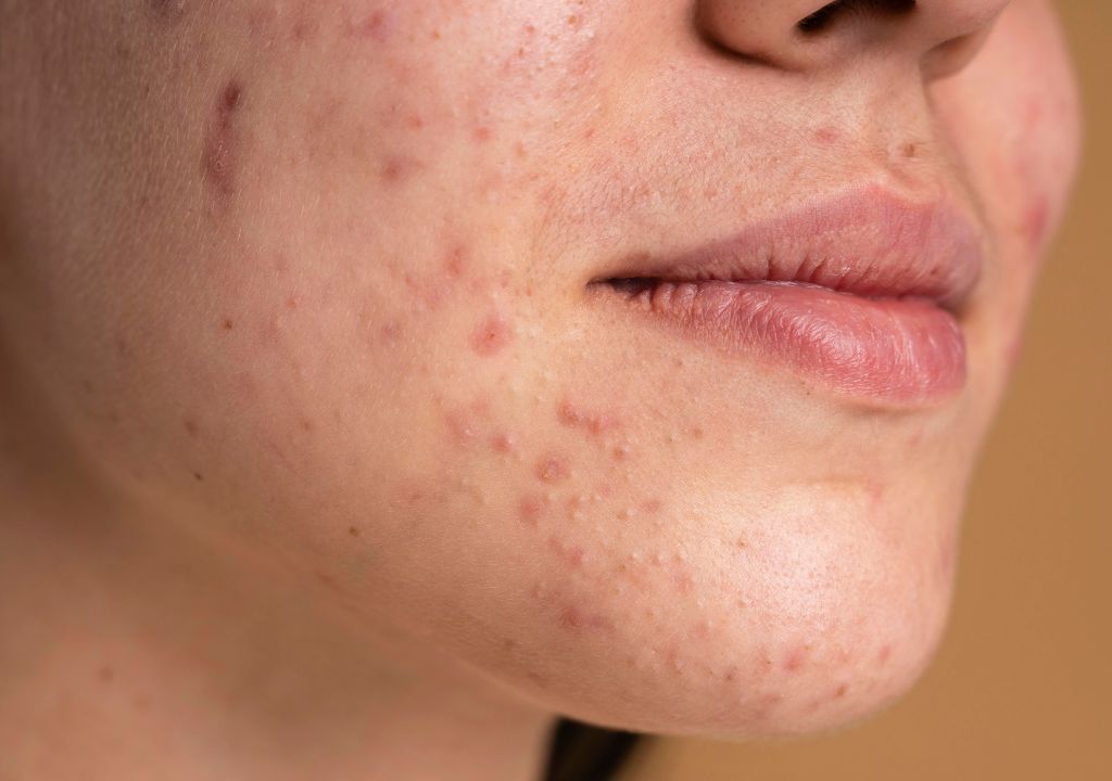 lady with blemish-prone skin