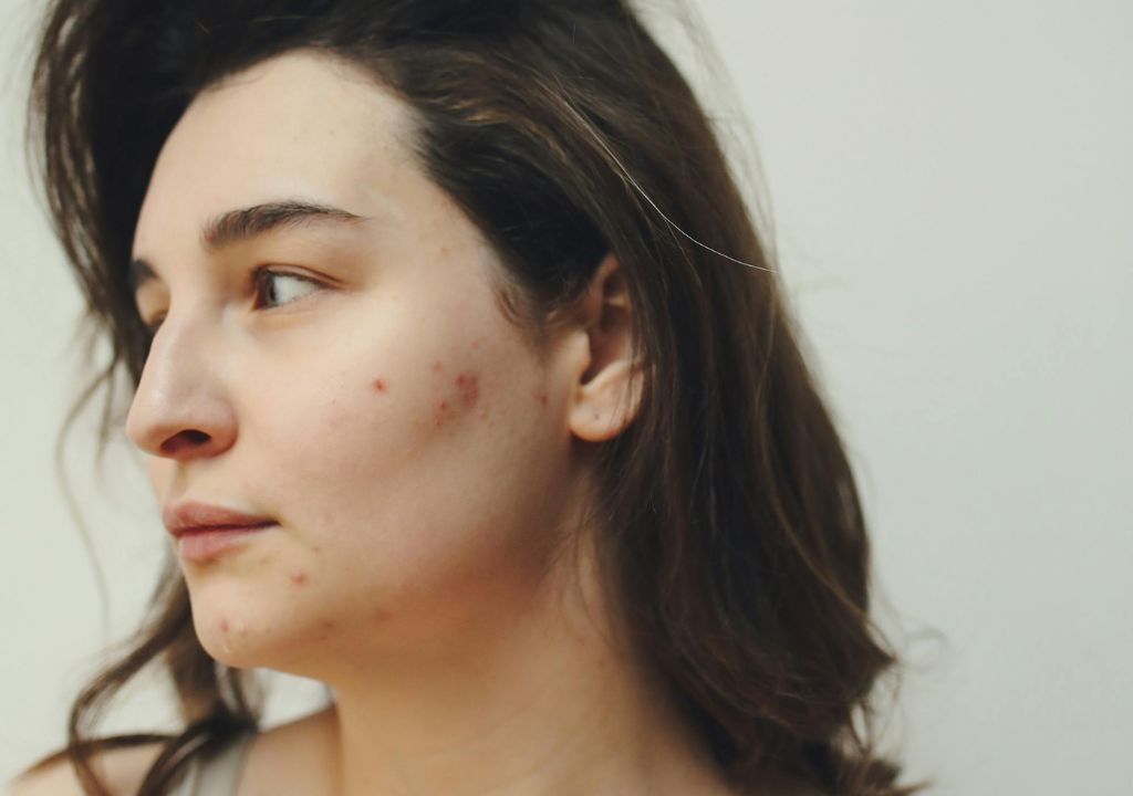 side profile of teenage sin with acne-prone skin