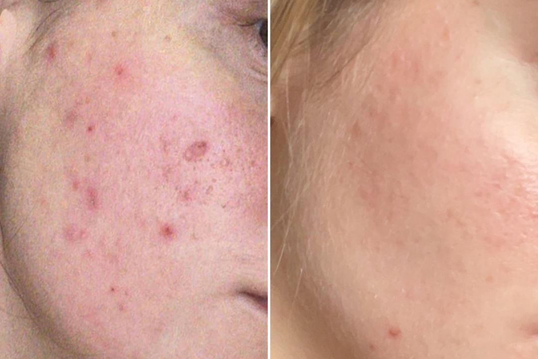 Tabby's Acne Skincare Journey: Our Top 6 Acne Skincare Solutions