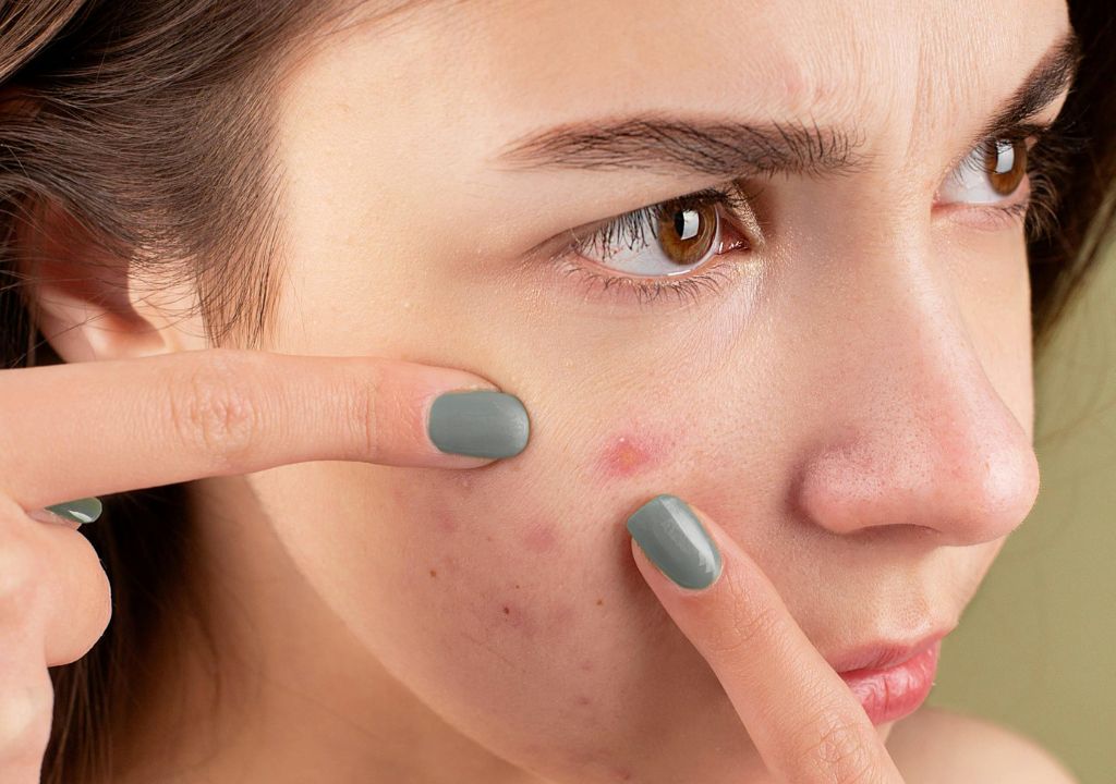 girl picking at acne-prone skin
