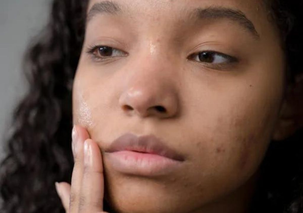 teenage girl with blemish-prone skin