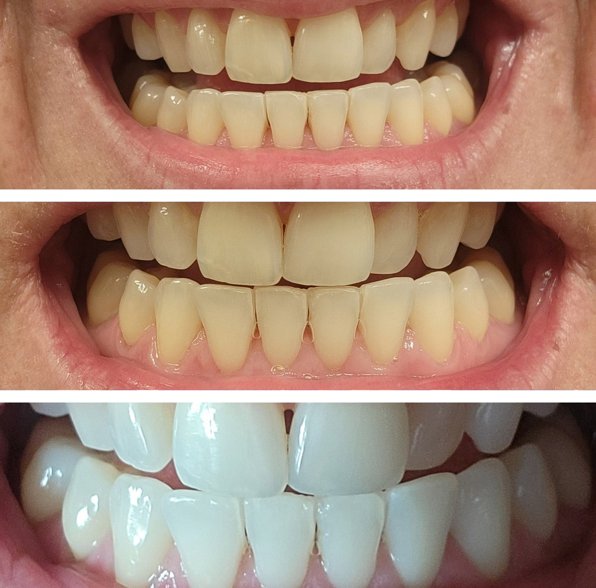 before and after results after use of mint teeth whitening