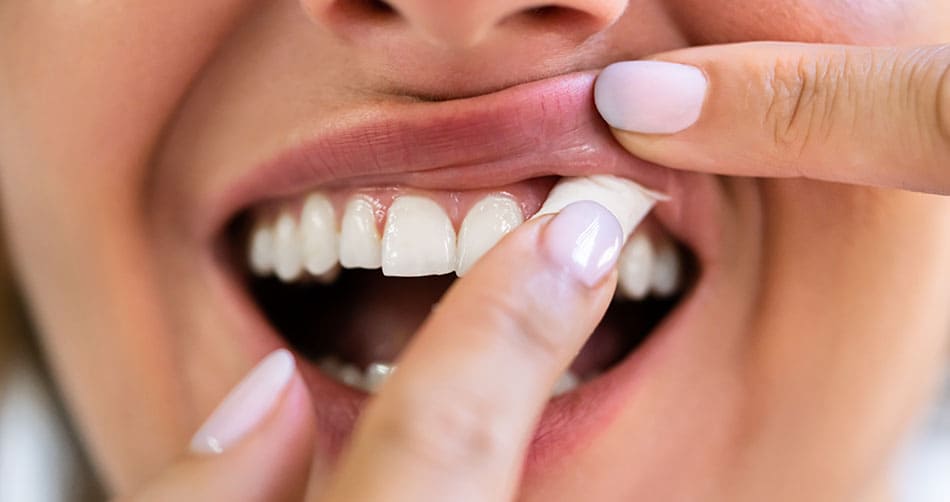 Woman placing a nicotine pouch between her upper lip and gum.