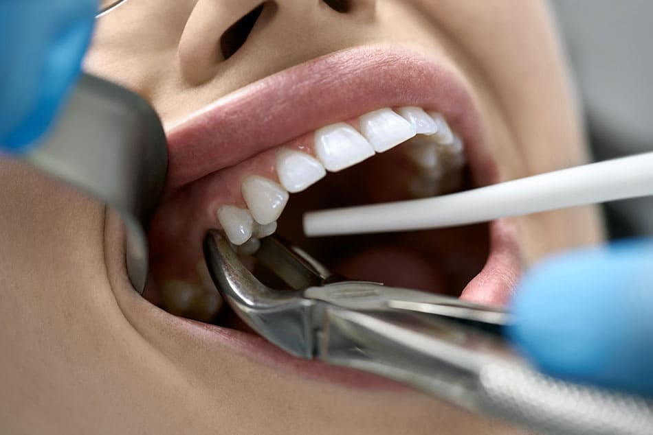 Woman with open mouth getting tooth extracted by dentist utensils and a suction device.