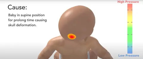 pressure of baby sleep position cause skull deformation or flat spot on baby head