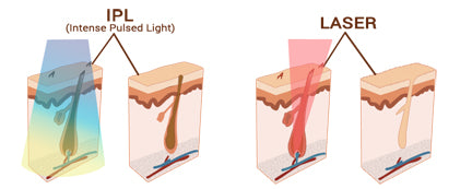 Skillnaden mellan IPL och laser