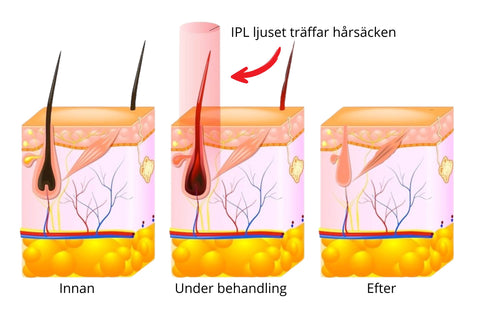 Så fungerar IPL