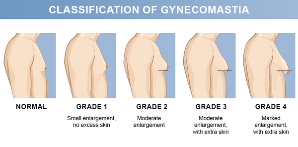Luhaka™ GynoPatch - Advanced Gynecomastia Reduction Patch