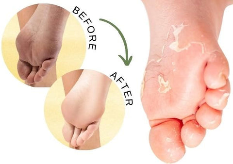 PediCare™ Anti-Fungal Herbal Foot Soak