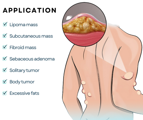 DermaFix™ Lipoma Removal Cream