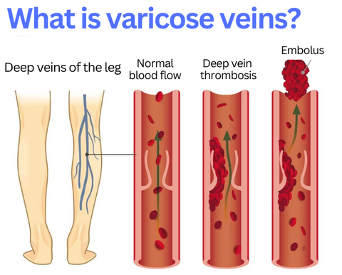 VeinGone™ Varicose Fading Cream