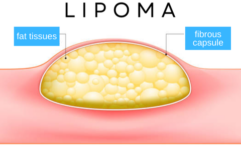 DermaFix™ Lipoma Removal Cream