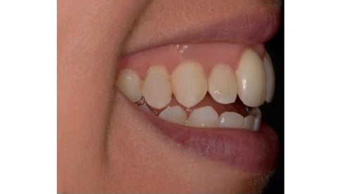 DentiZen™ Zahnfleisch-Therapie-Gel