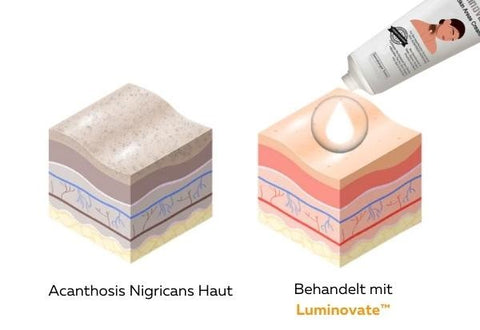 Luminovate™ Creme für dunkle Hautpartien