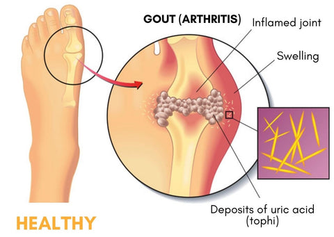 AcuHealth™ Gout Aid Toe Rings