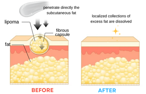 DermaFix™ Lipoma Removal Cream