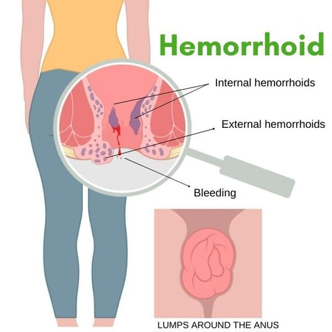 HemEase™ Hemorrhoid Spray