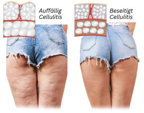 LeanVita™ Beinschlankheits- & Cellulite-Pflaster