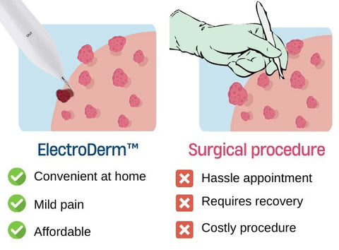 ElectroDerm™ Skin Tag Treatment Pen