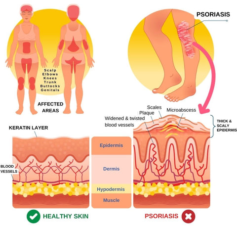 CalmSkin™ Psoriasis Defense Body Wash