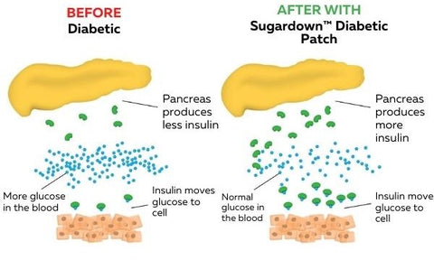 Oveallgo™ Sugardown Diabetic Patch Plus