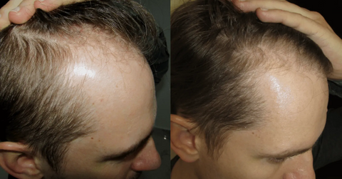 Barra de xampú HairMed™ Regrowth