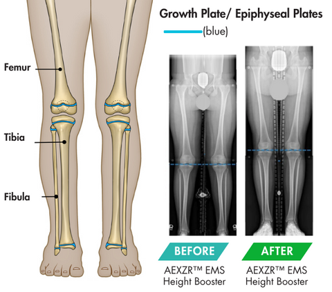 AEXZR™ EMS Height Booster