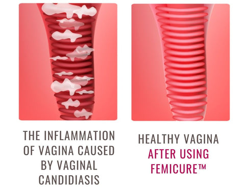 FemiCure™ Anti-Vaginal Candidiasis Shower Gel